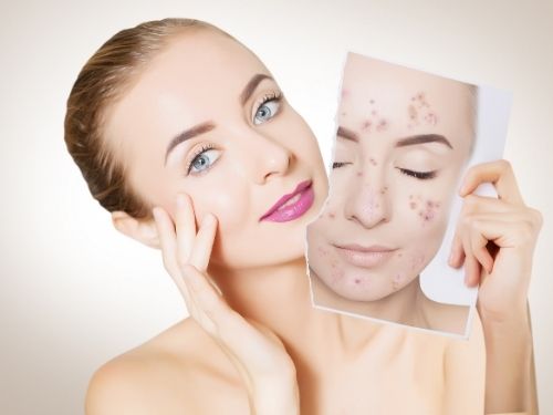 Acne mulher adulta Acne mulher adulta