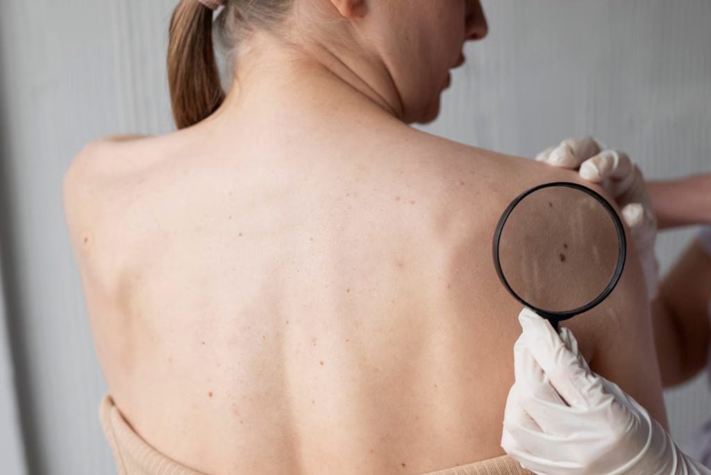 Atenção com o melanoma!